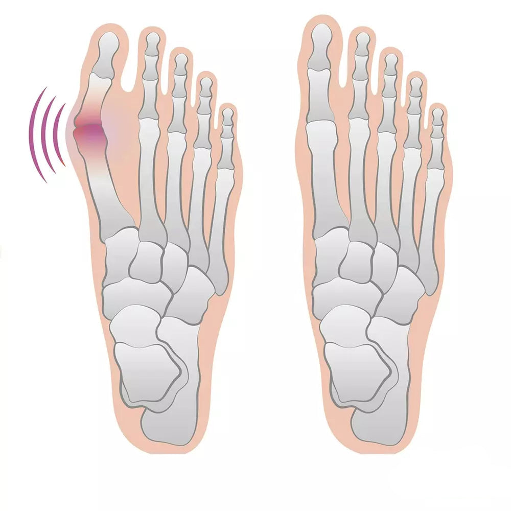 Gel Bunion Pads – Comfortable & Discreet Protection for Pain-Free Movement