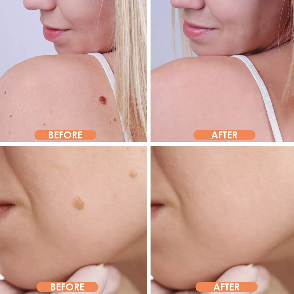 Plasma Pen – Remove Skin Tags, Moles & Blemishes Safely at Home