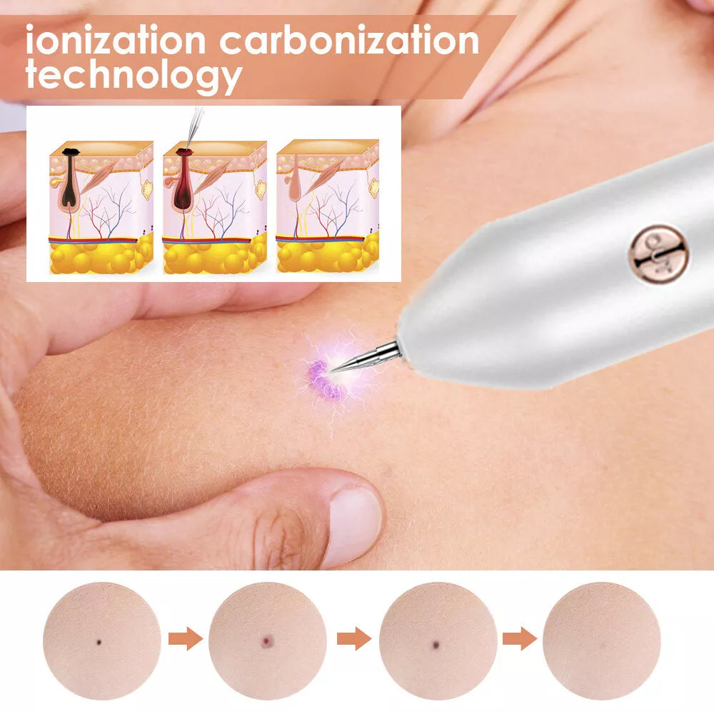 Plasma Pen – Remove Skin Tags, Moles & Blemishes Safely at Home