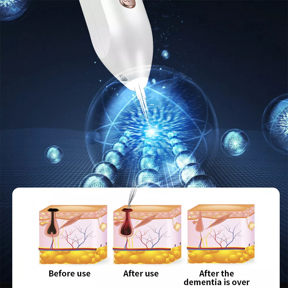 Plasma Pen – Remove Skin Tags, Moles & Blemishes Safely at Home