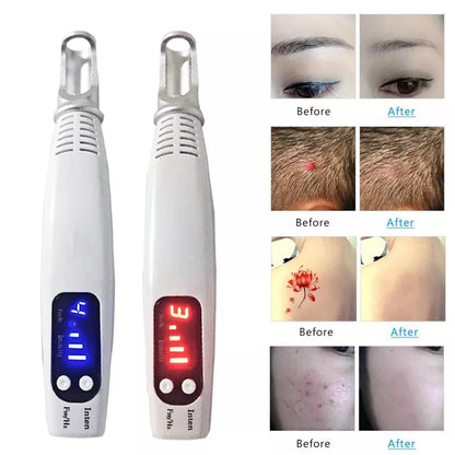 Tattoo & Blemish Removal Laser Pen – Safe & Effective Skin Care