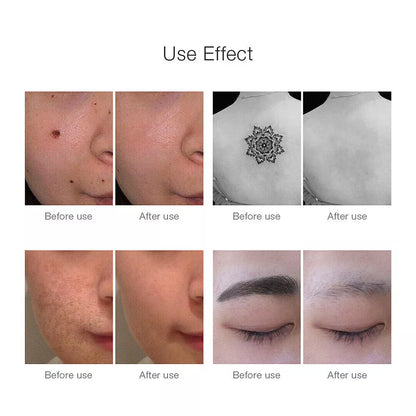 Tattoo & Blemish Removal Laser Pen – Safe & Effective Skin Care